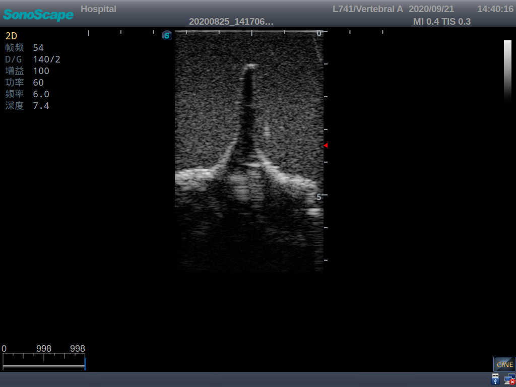 Adult Lumbar Puncture Ultrasound Training Model